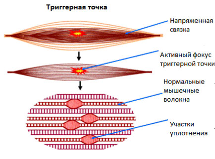 Миофасциальная боль