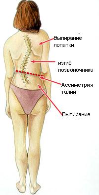 Лечение сколиоза