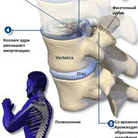 Остеохондроз. Причина боли. Диагностика и лечение.