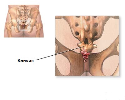 Кокцигодинией называют боль в копчике