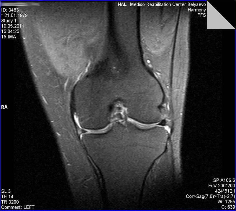 Разрыв мениска мрт. Снимки мрт повреждения мениска. Мрт коленного сустава разрыв мениска. Снимок мрт колена разрыв мениска. Травмы коленного сустава мрт снимки.