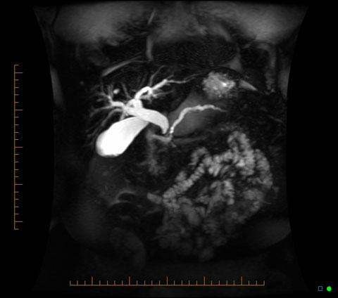 Исследование поджелудочной железы магнитно резонансной томографией