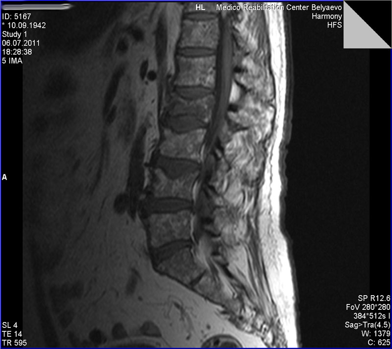 Мрт поясничного отдела позвоночника центр дикуля