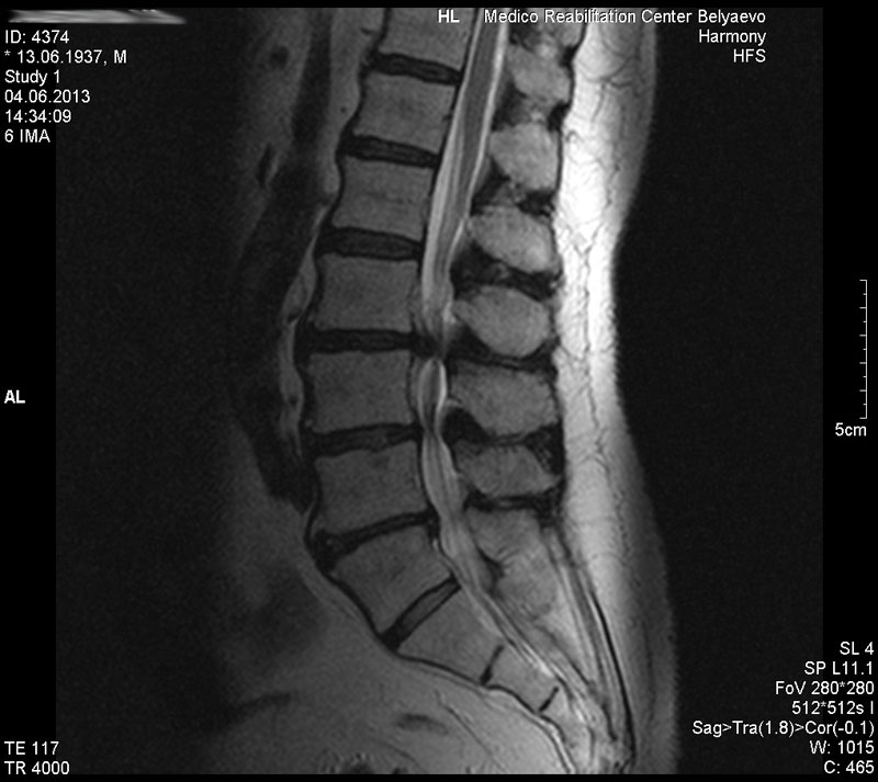 Мрт поясничного отдела позвоночника центр дикуля