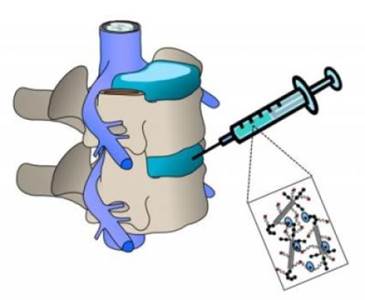 Стволовые клетки лечение позвоночника thumbnail