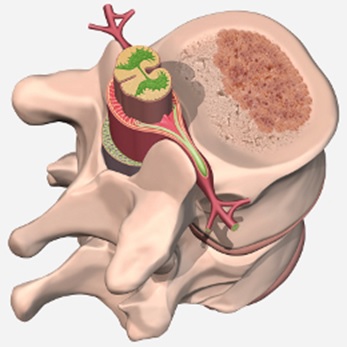 Удаление гемангиомы позвоночника хирургическим путем у взрослых