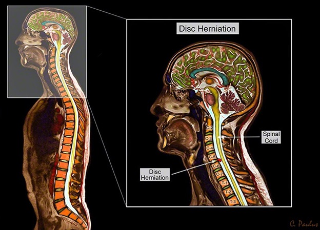 Мрт шейного отдела позвоночника с грыжами