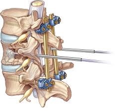 Дикуль операции на позвоночнике