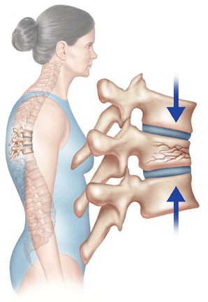 Лечения позвоночника компрессионный дисков