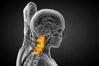 Головная боль при спондилезе шейного отдела позвоночника