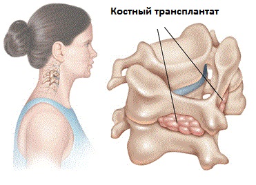 Коррекция верхнего отдела позвоночника