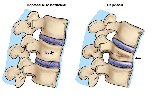 Дикуль после перелома позвоночника