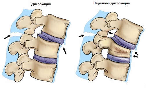 Программа дикуля при переломе позвоночника