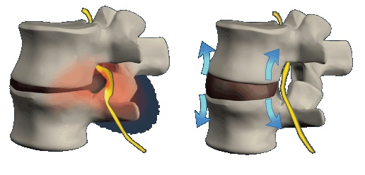 Лечение протрузии дисков позвоночника поясничного отдела в москве