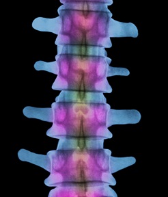 Как выглядит остеопороз на рентгеновском снимке