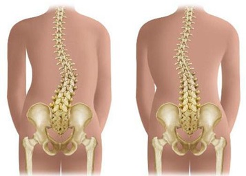 Виды и места локализации сколиоза 1 степени