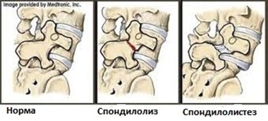 Деформация дисков позвоночника