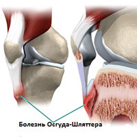 Болезнь Осгуда-Шляттера