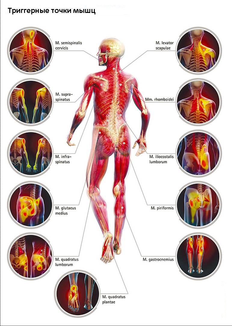Боли в мышцах - лечение, симптомы, причины, диагностика | Центр Дикуля