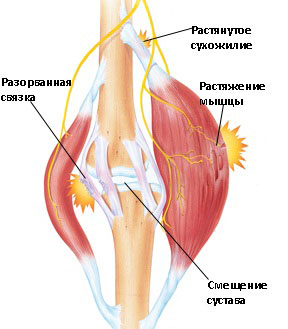 Накопление молочной кислоты