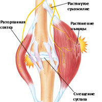 Боли в мышцах