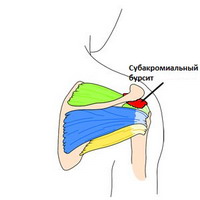 Что такое бурсит локтевого сустава