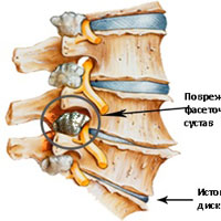 Деформирующий спондилез