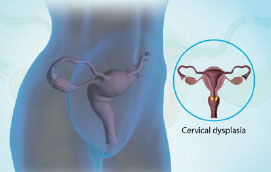 Дисплазия шейки матки