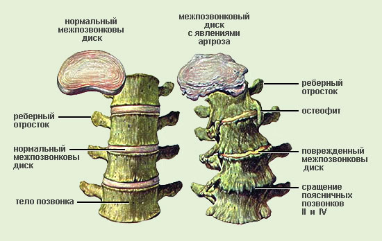 Грыжа диска