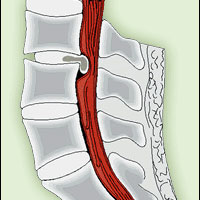 Межпозвоночная грыжа диска. Лечение грыжи позвоночника