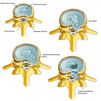 Грыжи диска с секвестрацией