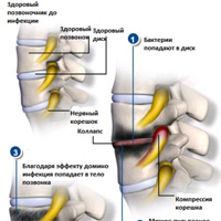 Инфекции позвоночника (спинальные инфекции)