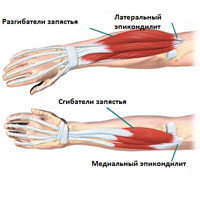 Эпикондилит (локоть теннисиста, локоть гольфиста)