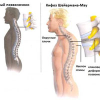 Кифоз Шейермана - мау