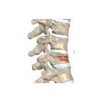 Компрессионный перелом позвоночника