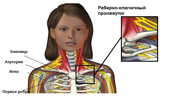 Синдром лестничной мышцы - лечение, симптомы, причины, диагностика | Центр  Дикуля