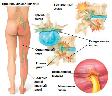 Защемление седалищного нерва - причины, симптомы, признаки, диагностика, лечение, профилактика