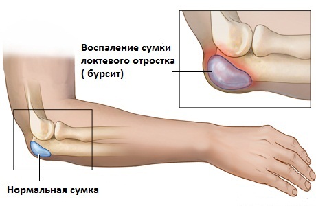 Локтевой бурсит - лечение, симптомы, причины, диагностика | Центр Дикуля