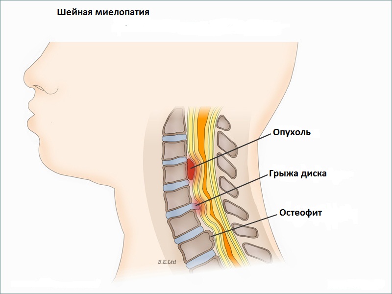 Миелопатия - лечение, симптомы, причины, диагностика | Центр Дикуля