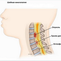 Миелопатия