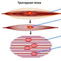 Миофасциальная боль