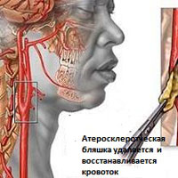 Хроническое нарушение мозгового кровообращения