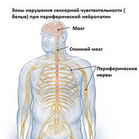 Периферическая нейропатия