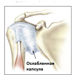 Изображение - Нестабильность плечевого сустава лечение nestabilnost-plechevogo-sustava2