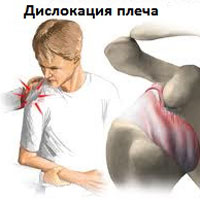 Нестабильность плечевого сустава