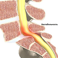 Нестабильность позвоночно-двигательного сегмента