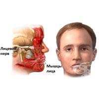 Невропатия лицевого нерва
