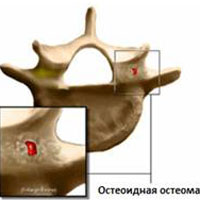 Опухоли позвоночника