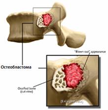 Опухоли позвоночника