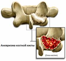 Отек спинного мозга позвоночника последствия thumbnail